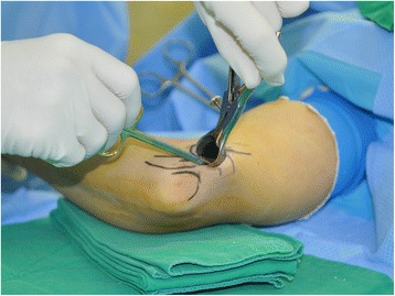 Cubital Tunnel Release Ulnar Nerve Transposition — Fig. 2