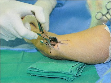 Cubital Tunnel Release Ulnar Nerve Transposition — Fig. 3