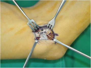 Cubital Tunnel Release Ulnar Nerve Transposition — Fig. 4