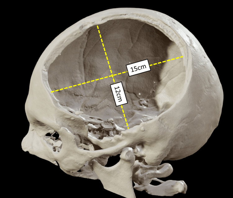 Decompressive Craniectomy Traumatic Brain Injury — Figure 1