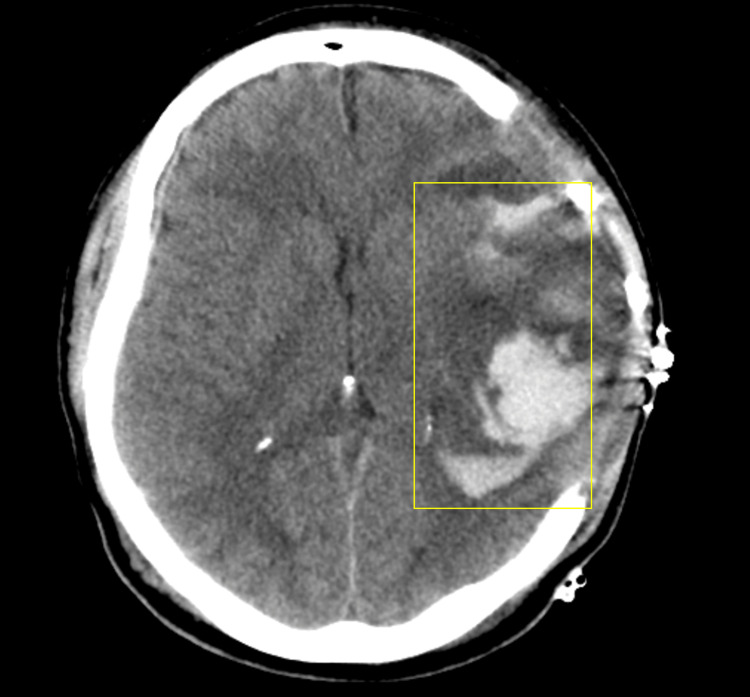 Decompressive Craniectomy Traumatic Brain Injury — Figure 2