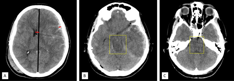 Decompressive Craniectomy Traumatic Brain Injury — Figure 3