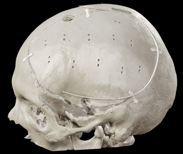 Decompressive Craniectomy Traumatic Brain Injury — Figure 4
