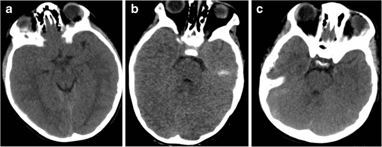 Decompressive Craniectomy Traumatic Brain Injury — Fig. 2