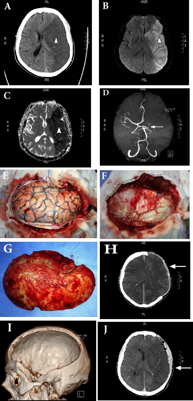 Decompressive Hemicraniectomy Malignant MCA Infarction — Figure 1