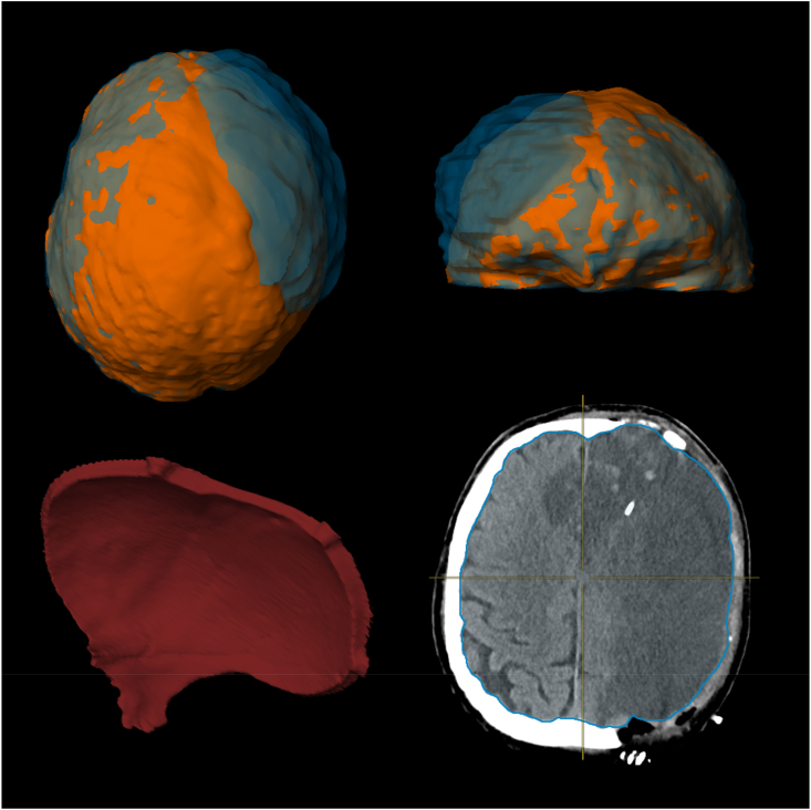 Decompressive Hemicraniectomy Malignant MCA Infarction — Fig. 1
