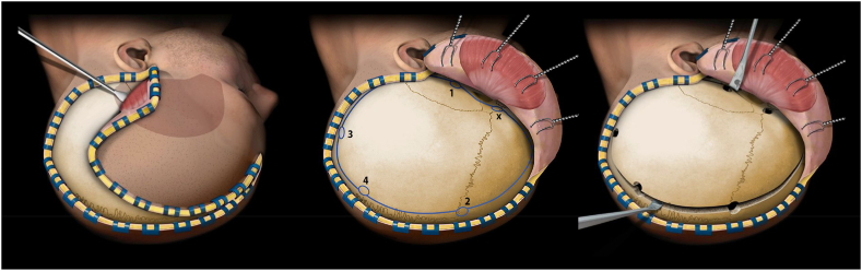 Decompressive Hemicraniectomy Malignant MCA Infarction — Fig. 2