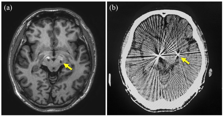 Deep Brain Stimulation Lead Placement — Figure 2.