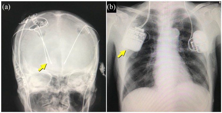 Deep Brain Stimulation Lead Placement — Figure 3.