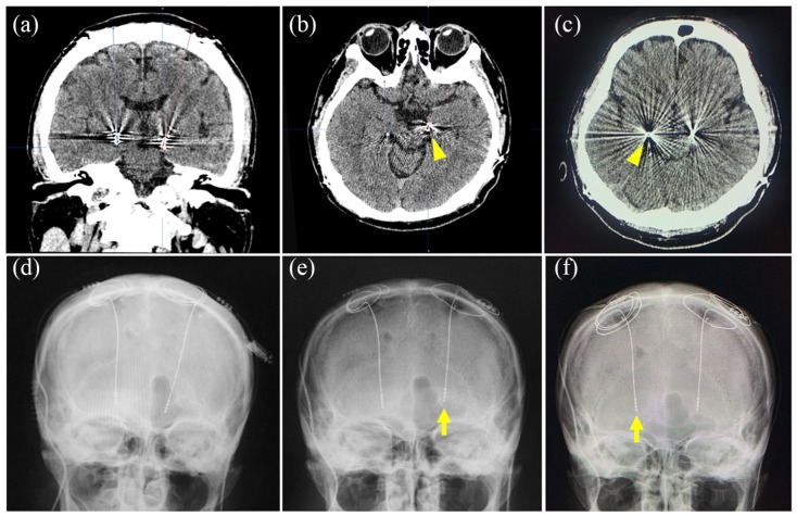 Deep Brain Stimulation Lead Placement — Figure 4.
