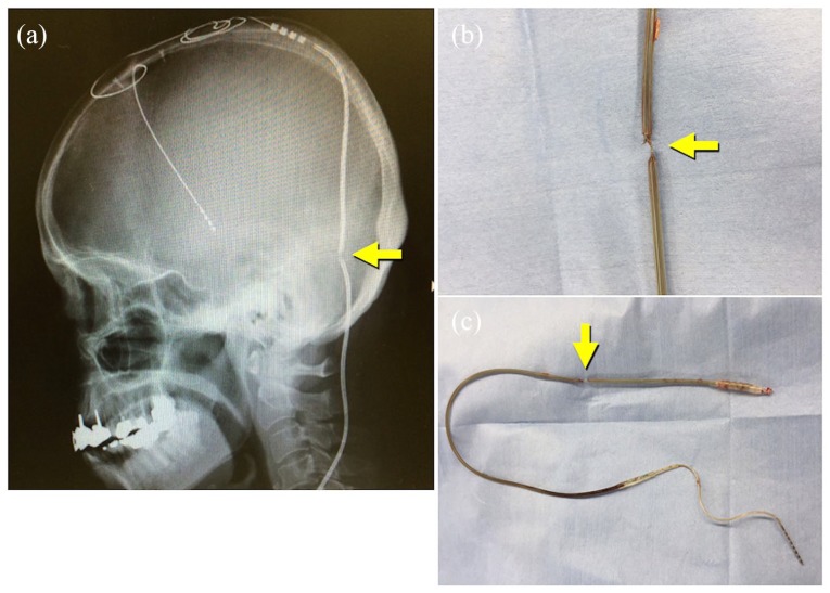 Deep Brain Stimulation Lead Placement — Figure 5.