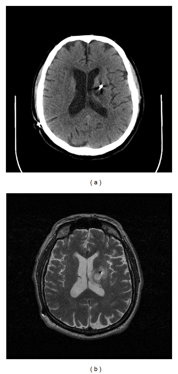 Deep Brain Stimulation Lead Placement — Figure 1