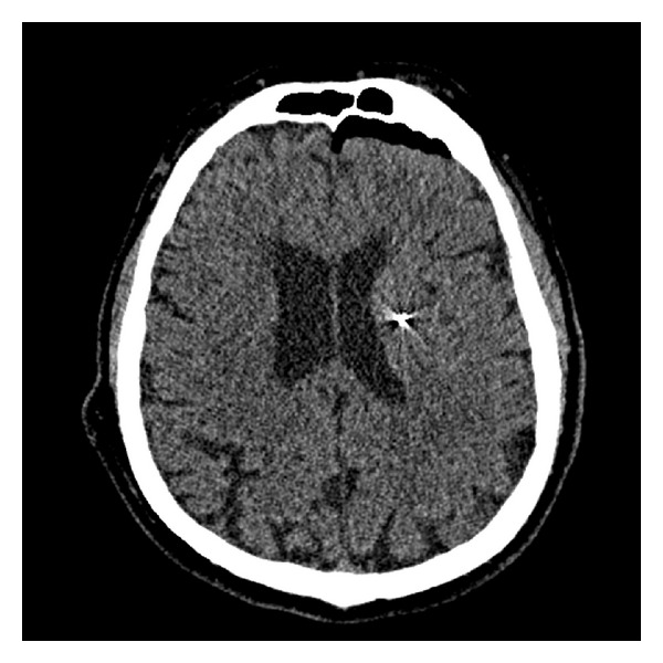 Deep Brain Stimulation Lead Placement — Figure 2