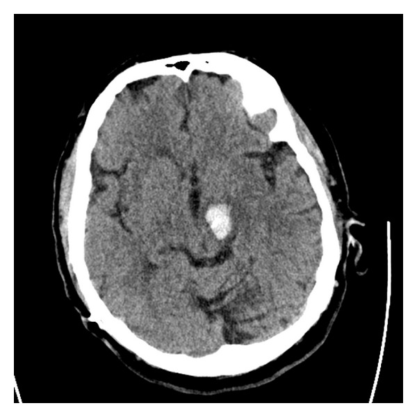 Deep Brain Stimulation Lead Placement — Figure 3