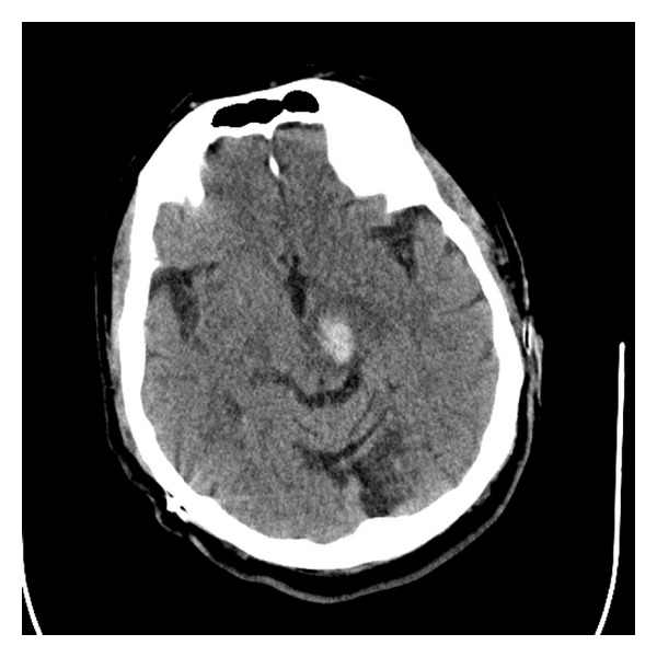 Deep Brain Stimulation Lead Placement — Figure 4