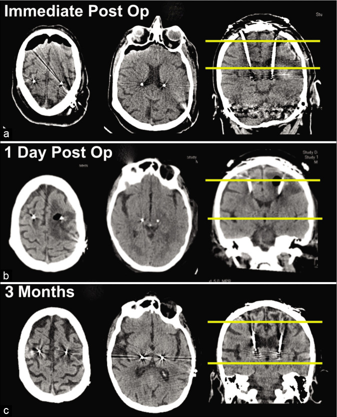 Deep Brain Stimulation Lead Placement — Figure 1:
