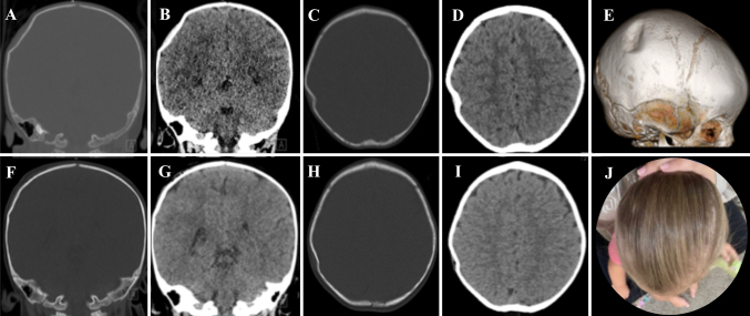 Depressed Skull Fracture Elevation — FIG. 1.