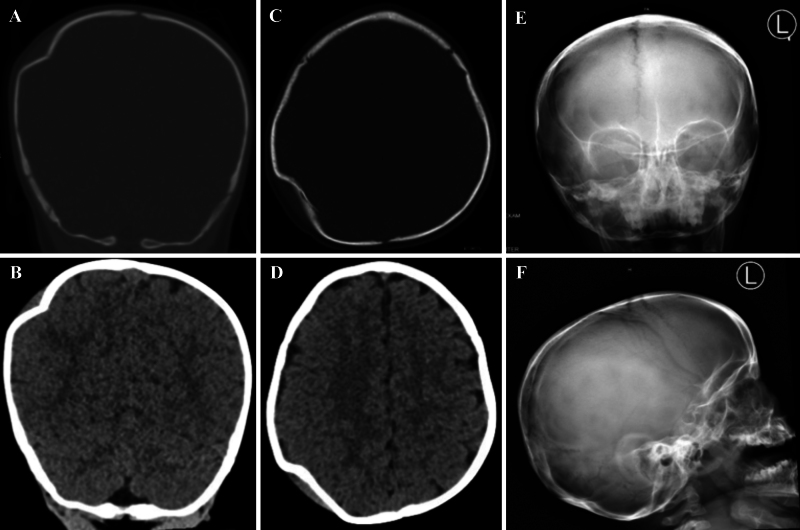 Depressed Skull Fracture Elevation — FIG. 3.