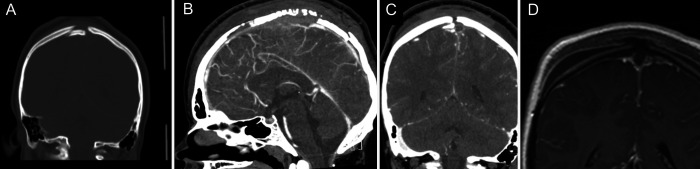 Depressed Skull Fracture Elevation — FIG. 1.