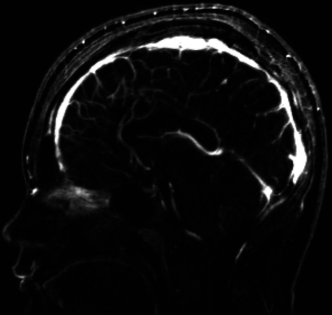 Depressed Skull Fracture Elevation — FIG. 2.