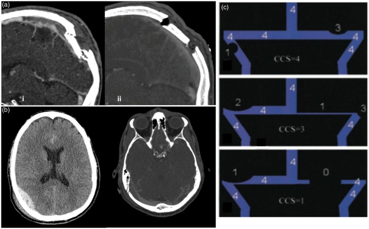 Depressed Skull Fracture Elevation — Figure 4.