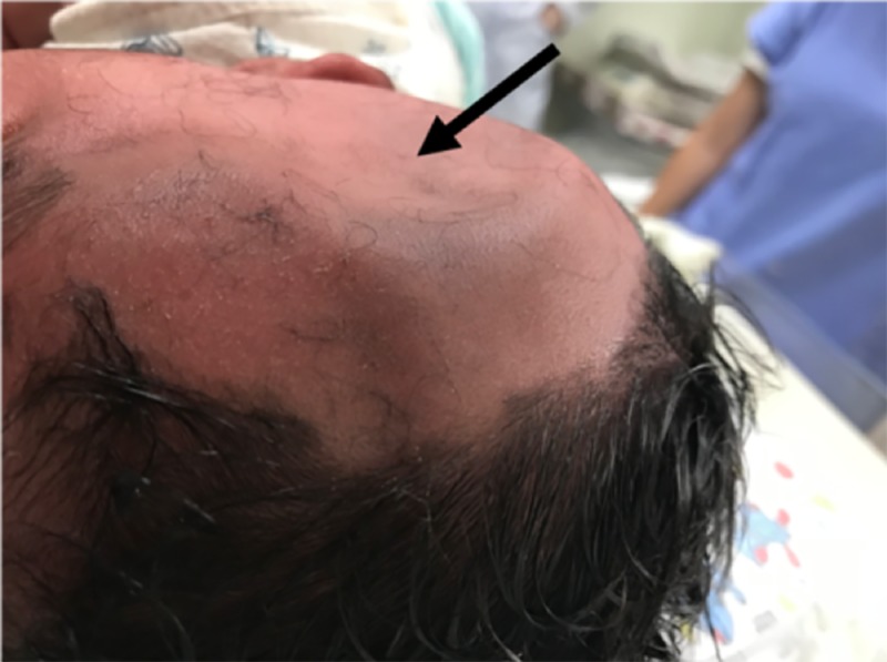 Depressed Skull Fracture Elevation — Figure 1