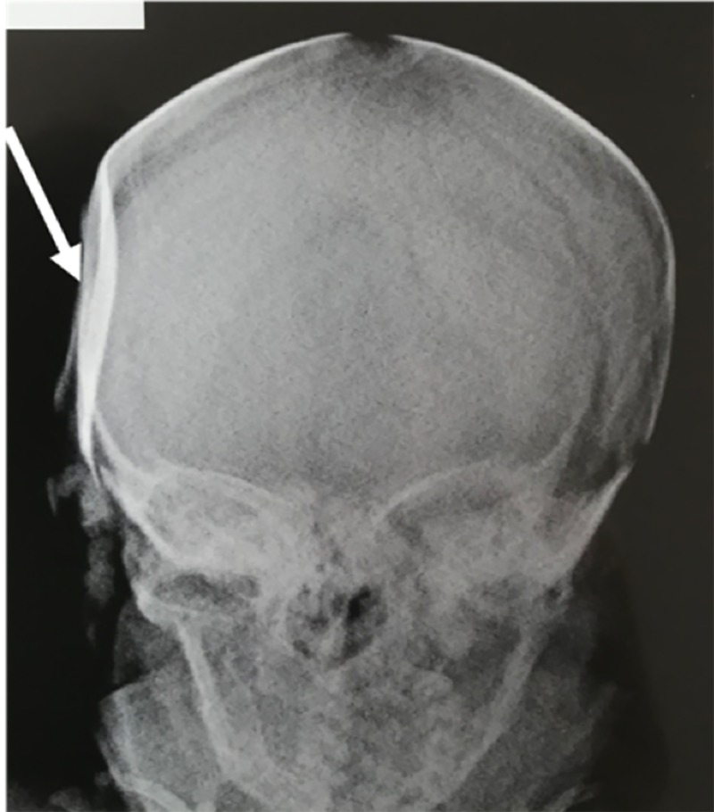 Depressed Skull Fracture Elevation — Figure 2