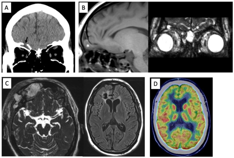 Encephalocele Repair — Figure 1