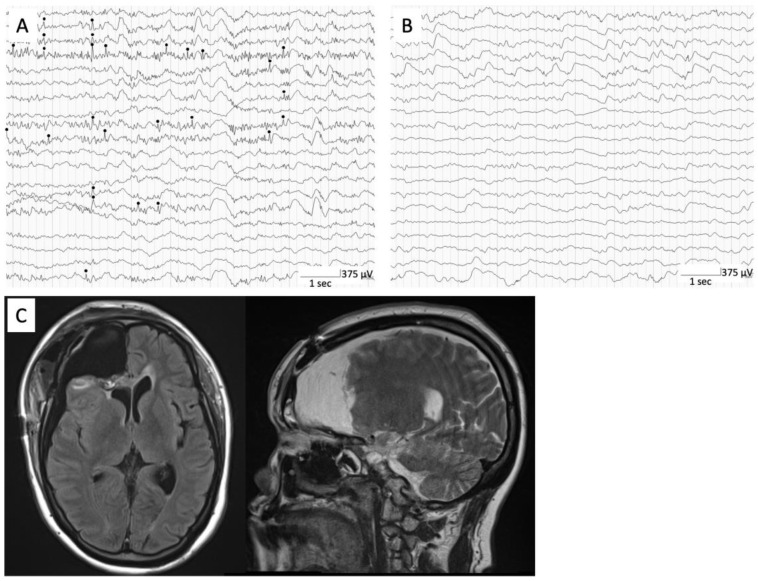 Encephalocele Repair — Figure 2