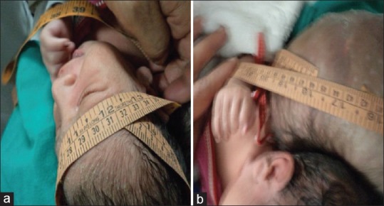 Encephalocele Repair — Figure 1