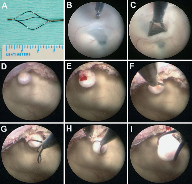 Endoscopic Third Ventriculostomy — FIG. 2.
