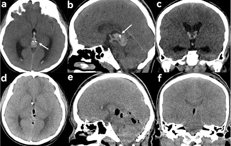 Endoscopic Third Ventriculostomy — Figure 1