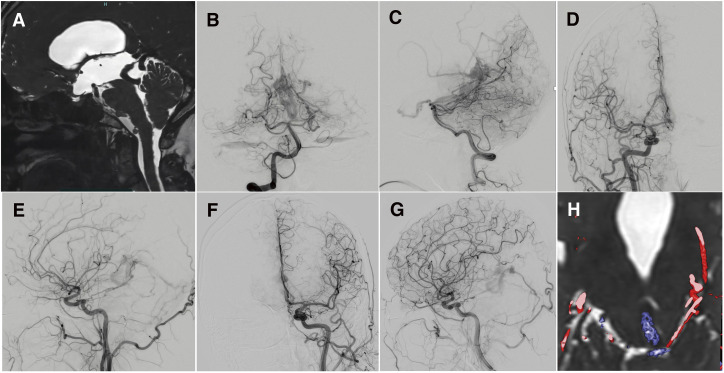 Endoscopic Third Ventriculostomy — Fig. 1