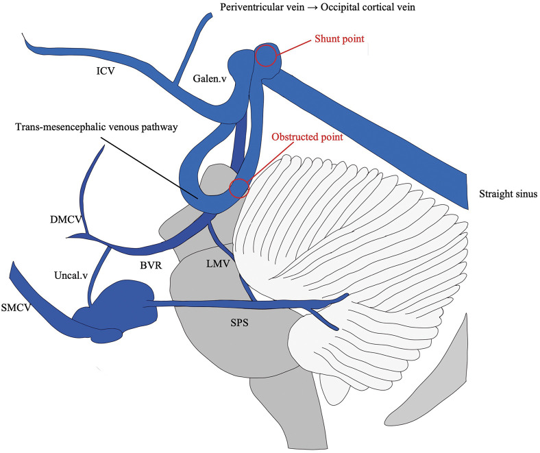 Endoscopic Third Ventriculostomy — Fig. 2
