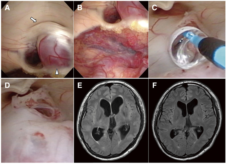 Endoscopic Third Ventriculostomy — Fig. 3