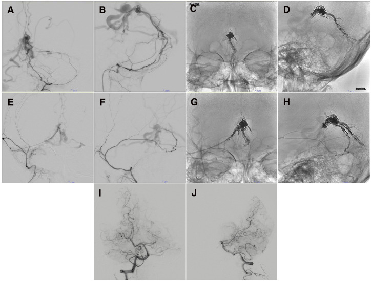 Endoscopic Third Ventriculostomy — Fig. 4