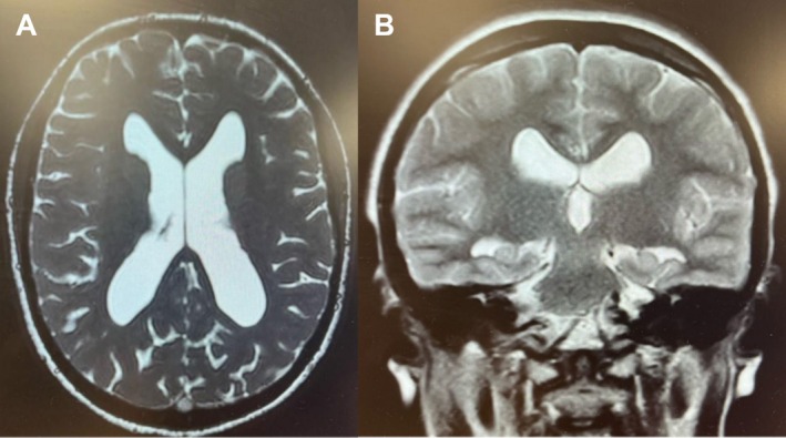 Endoscopic Third Ventriculostomy — FIGURE 3