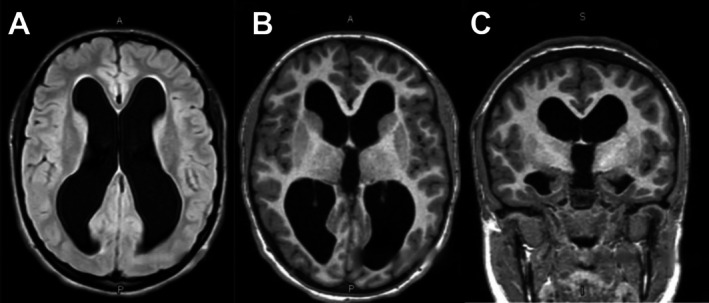 Endoscopic Third Ventriculostomy — FIGURE 2