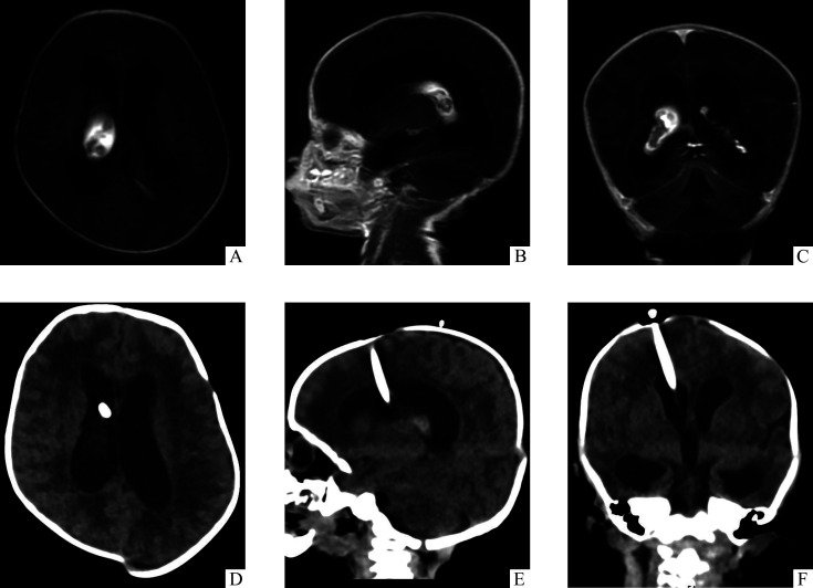 Endoscopic Third Ventriculostomy — 图1