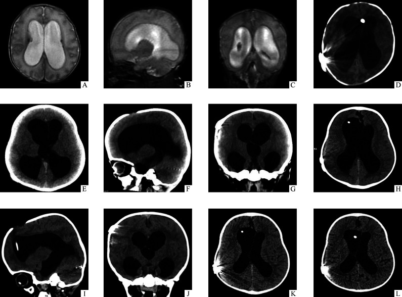 Endoscopic Third Ventriculostomy — 图2