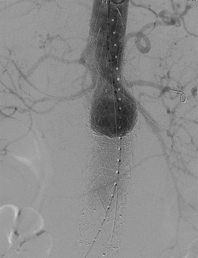 Endovascular Aneurysm Treatment — Fig 1
