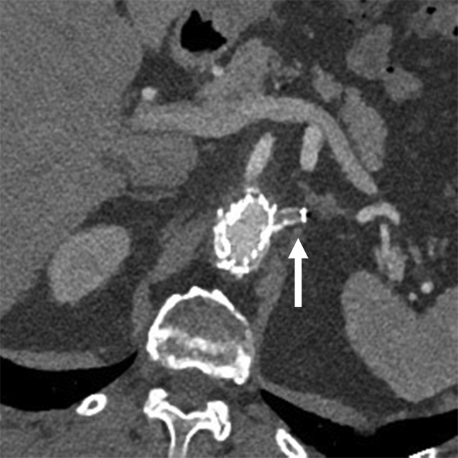 Endovascular Aneurysm Treatment — Fig 2