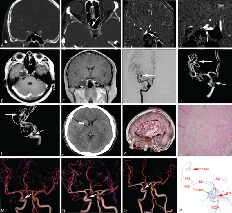 Epidermoid Tumor Resection — Figure 1