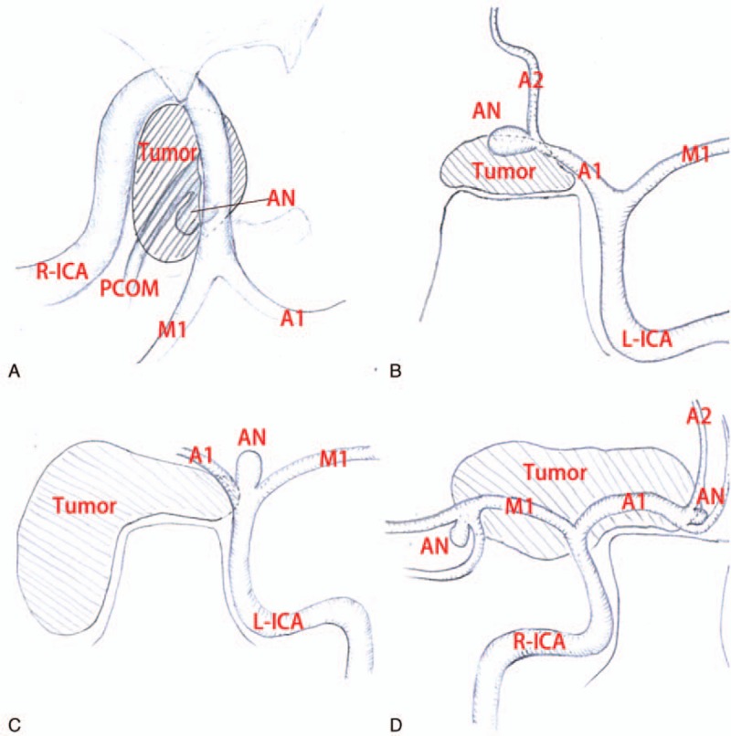 Epidermoid Tumor Resection — Figure 2