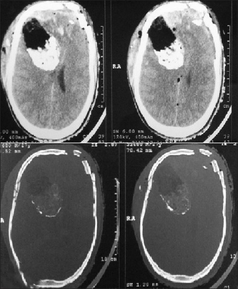 Epidermoid Tumor Resection — Figure 1