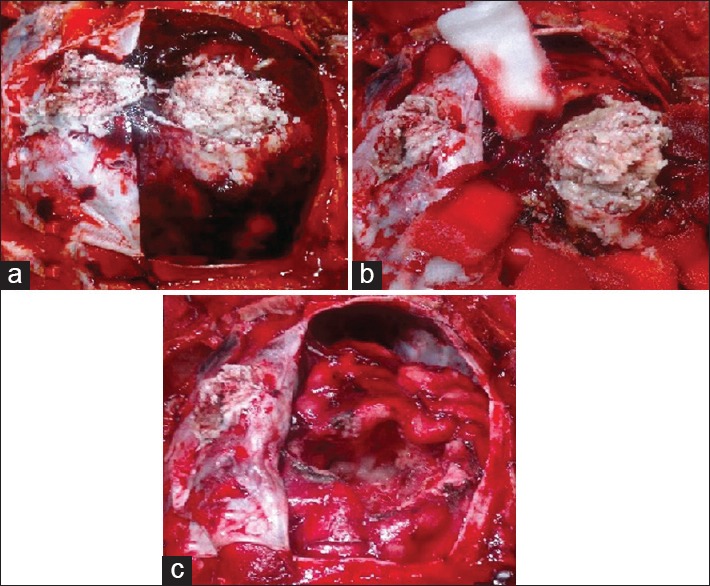 Epidermoid Tumor Resection — Figure 2