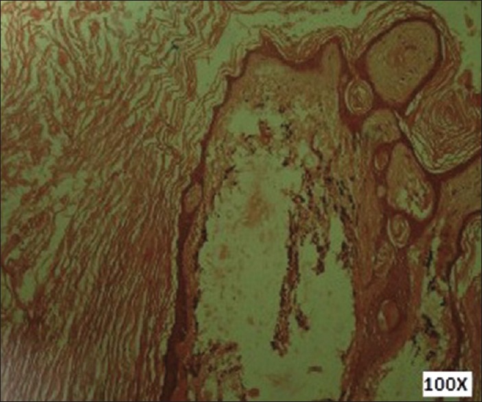 Epidermoid Tumor Resection — Figure 3