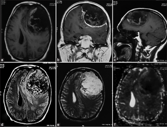 Epidermoid Tumor Resection — Figure 1