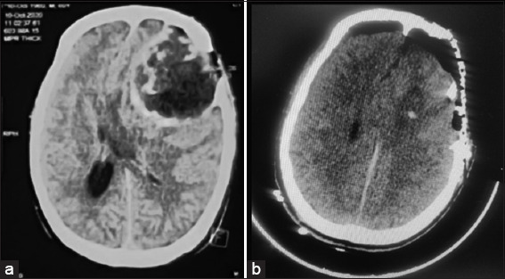 Epidermoid Tumor Resection — Figure 2