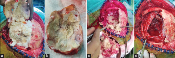 Epidermoid Tumor Resection — Figure 3